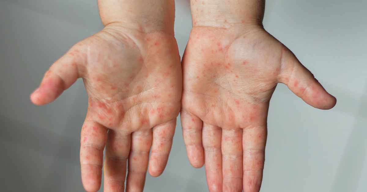 Hogyan kezeljük otthon?